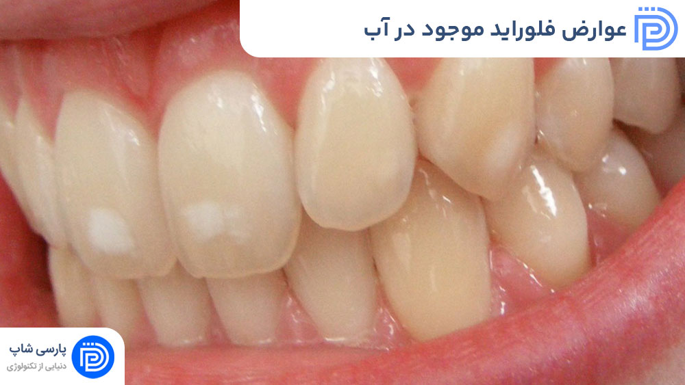 عوارض فلوراید موجود در آب